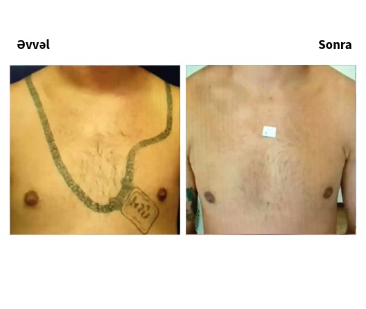 Lutronic Hollywood Spectra